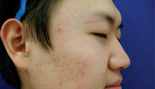 激光治疗痤疮 激光治疗痤疮能除根吗