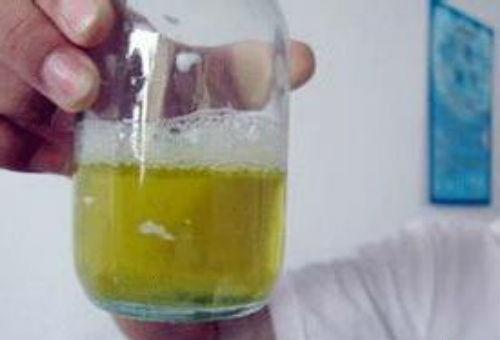 尿蛋白弱阳性是什么情况 尿蛋白弱阳性是什么情况