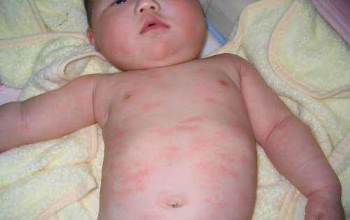 寒冷性荨麻疹的治疗方法 寒冷性荨麻疹的治疗办法