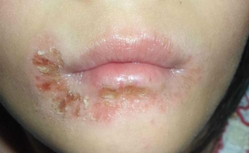 口周湿疹的偏方 口周湿疹中医治疗