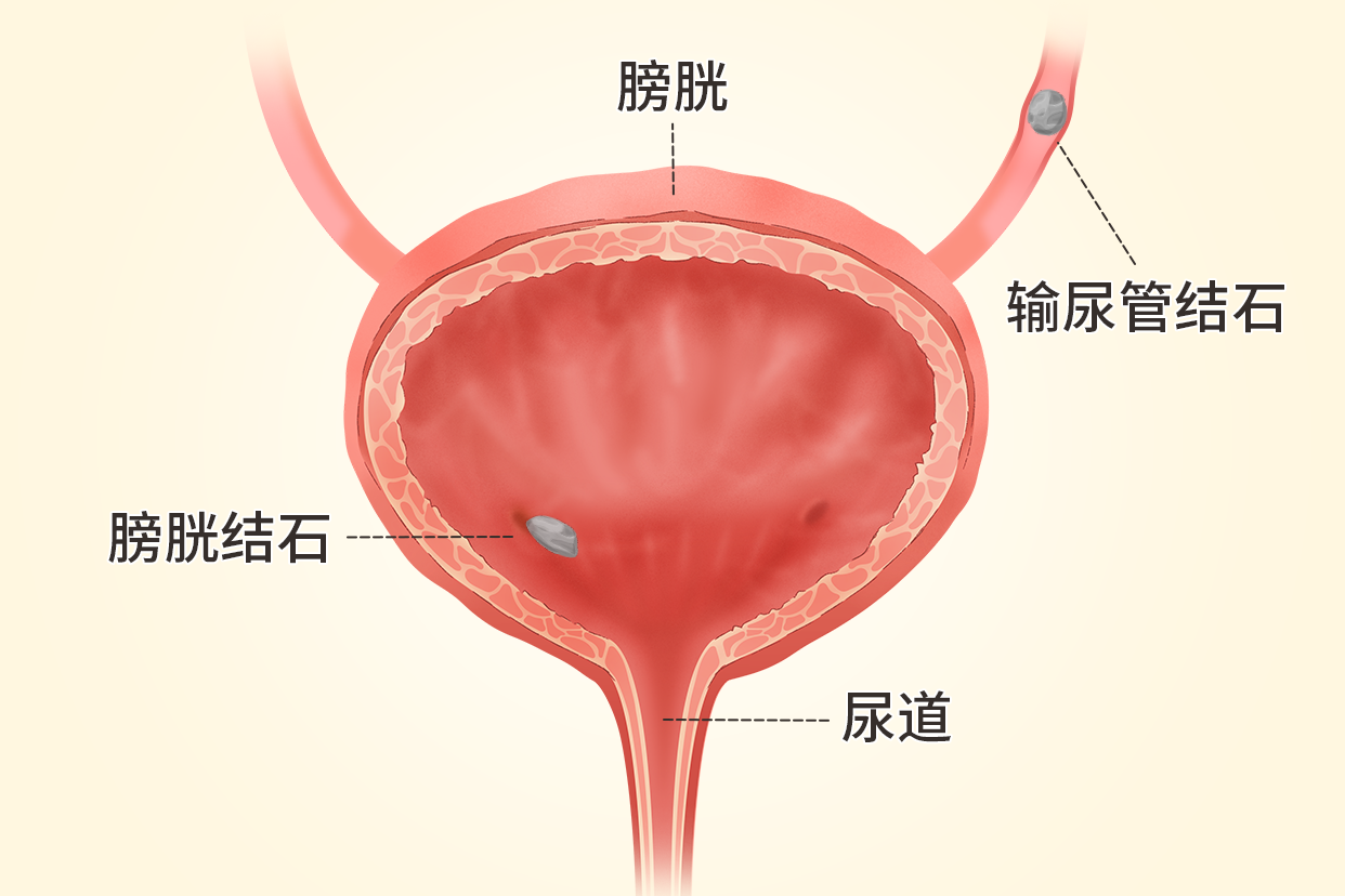 男生膀胱结石在什么位置图片（男性膀胱结石的部位图片）