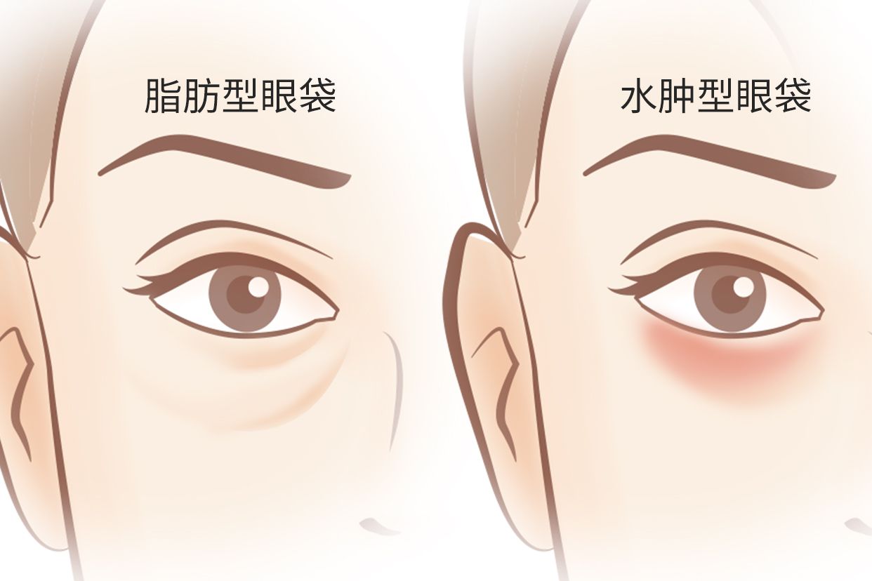 脂肪型眼袋和水肿型眼袋区别图 脂肪型眼袋与水肿型眼袋的图片