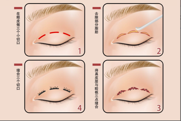 三点微创双眼皮图片 三点微创双眼皮