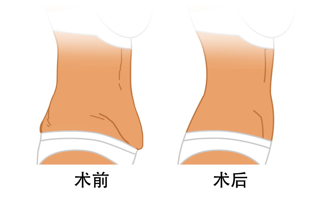 腹壁整形术前后效果图（腹壁整形术前后效果图片）