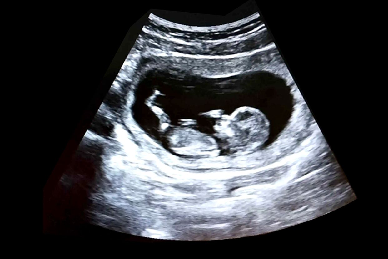 nt的胎儿图片可以看出脸型吗 胎儿nt照片五官很清楚