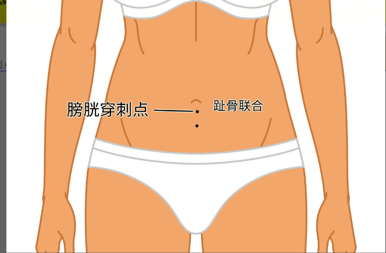 膀胱穿刺点的位置图片（膀胱穿刺排尿的部位）