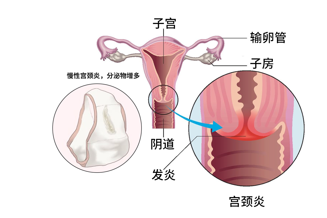 慢性宫颈炎内裤的图片（慢性子宫颈炎图片）