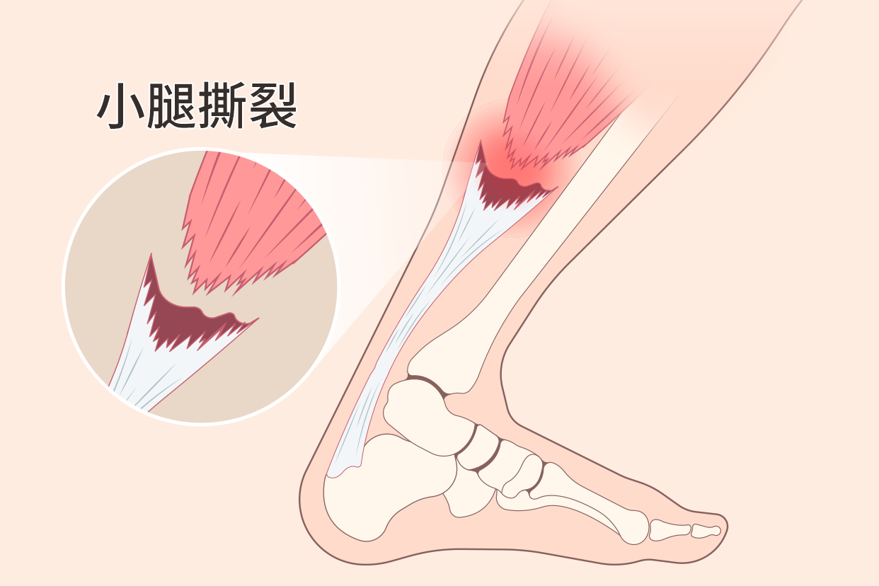 小腿肌肉撕裂图 小腿肌肉撕裂图解