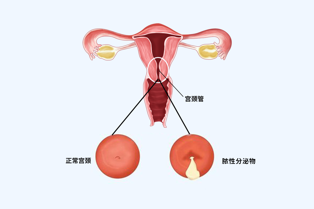 宫颈管内膜炎图片（宫颈管内膜炎图片）