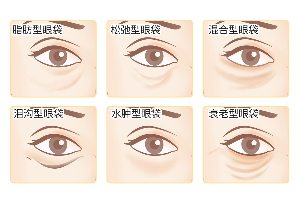 六种眼袋类型图片（六种眼袋类型图片大全）