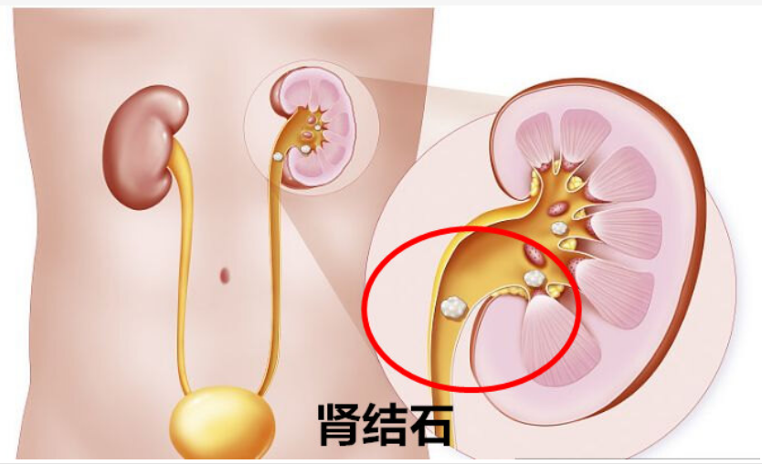 肾结节图片（肾结节百科）