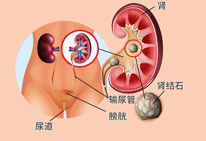 左肾结石一般在哪个位置图 右肾结石在哪个位置