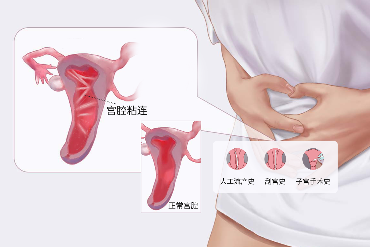 宫腔粘连和正常区别图（宫腔粘连和正常区别图片对比）