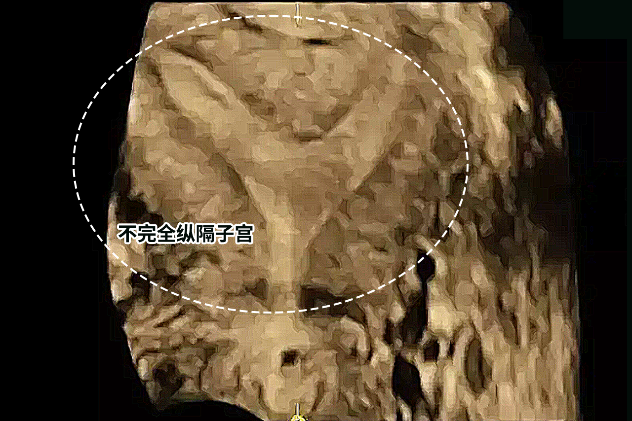 不完全纵隔子宫b超图 不完全纵隔子宫b超图片