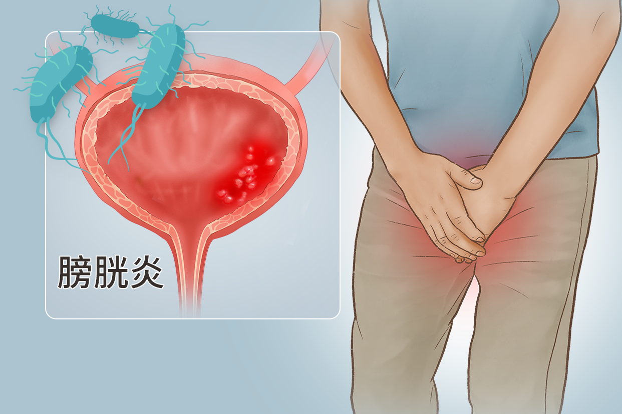 男性膀胱炎图片（男性膀胱炎图片真实）
