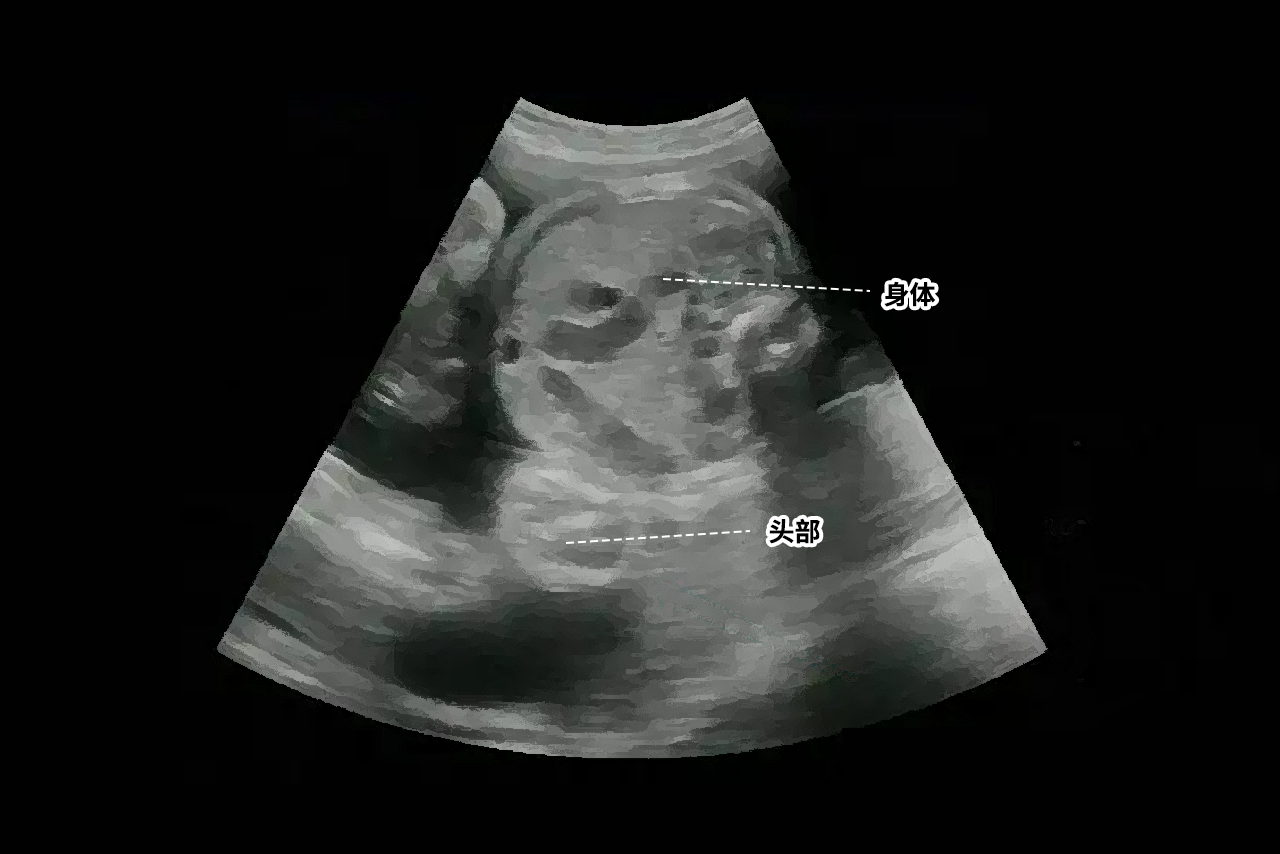 b超胎儿倒立着的图片 b超胎儿倒立着的图片怎么看