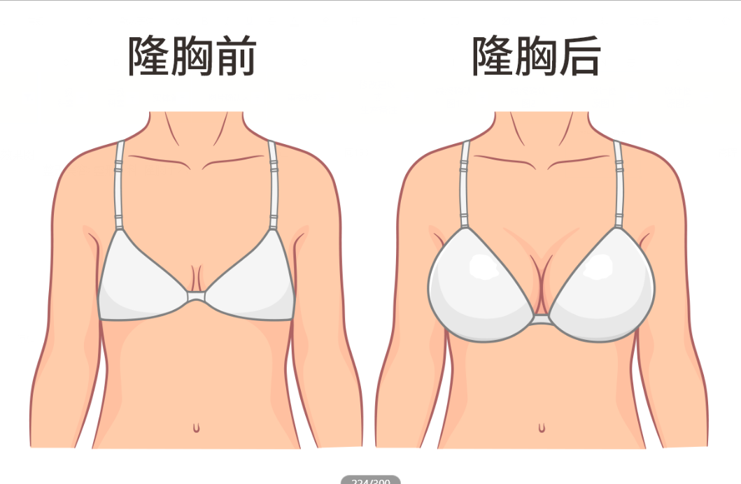 隆胸手术效果图片 隆胸手术后效果图