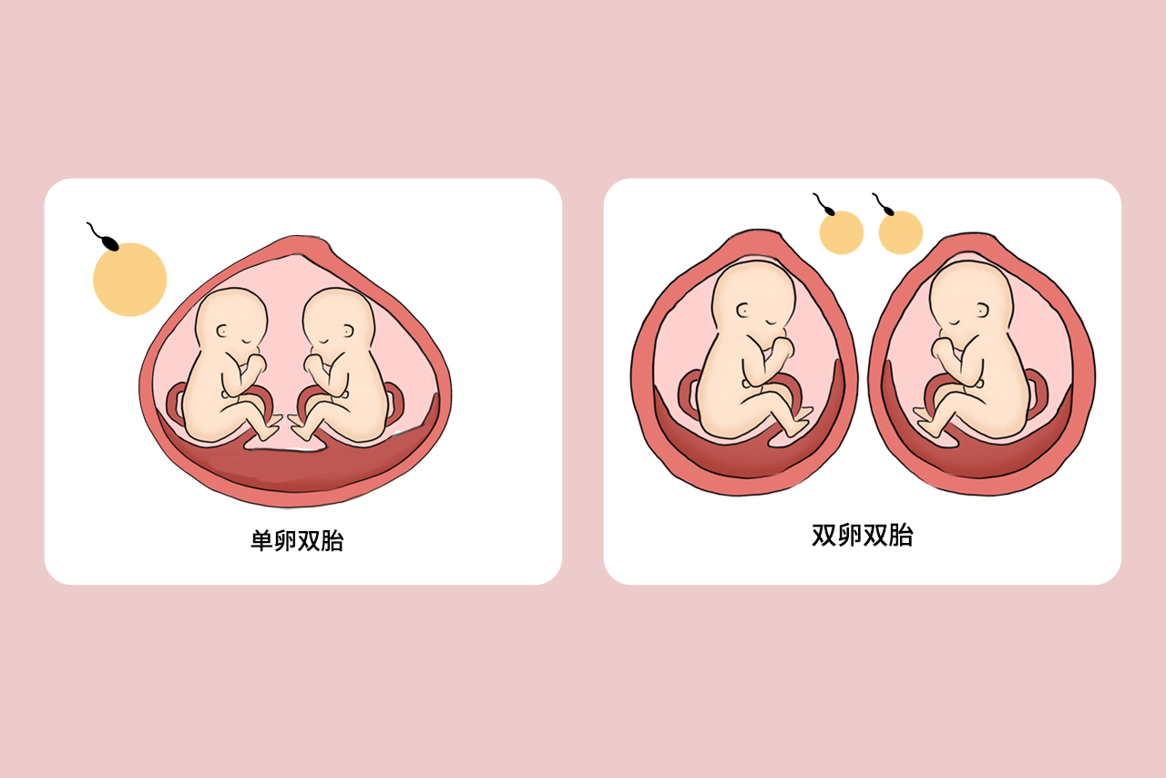 单卵双胎和双卵双胎区别图解 单卵双胎和双卵双胎区别图解大全