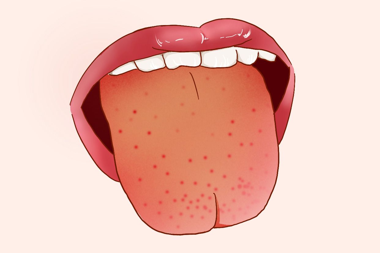 舌头黄苔还有红点图片 舌苔黄舌头上有红点