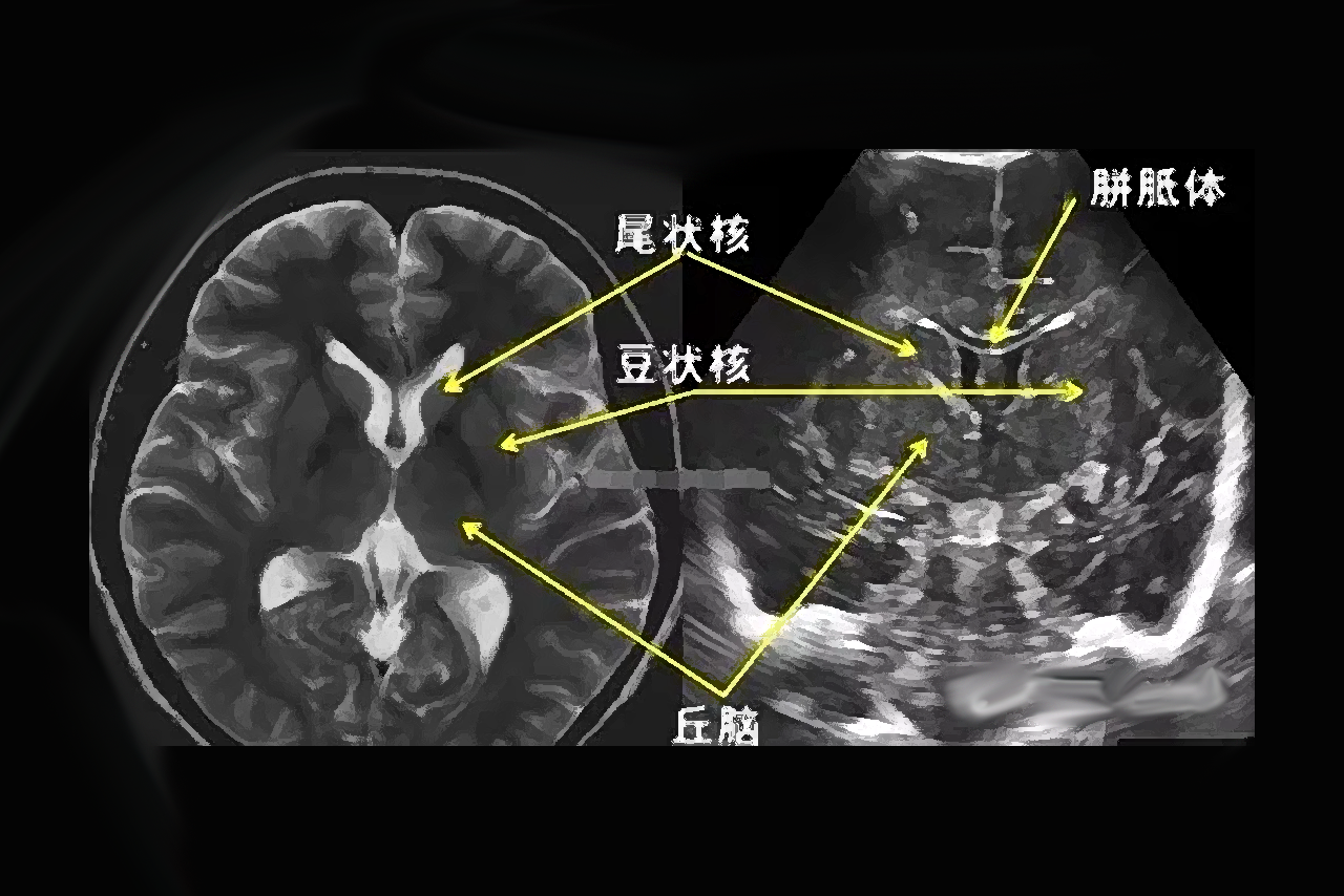 胎儿颅内结构正常超声图谱 胎儿脑部结构超声图