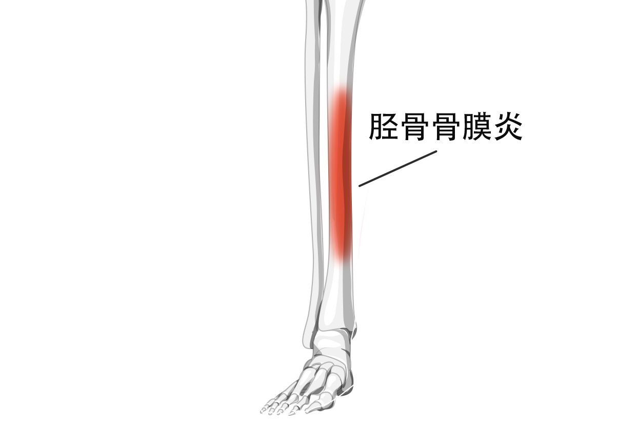 小腿胫骨骨膜炎图片