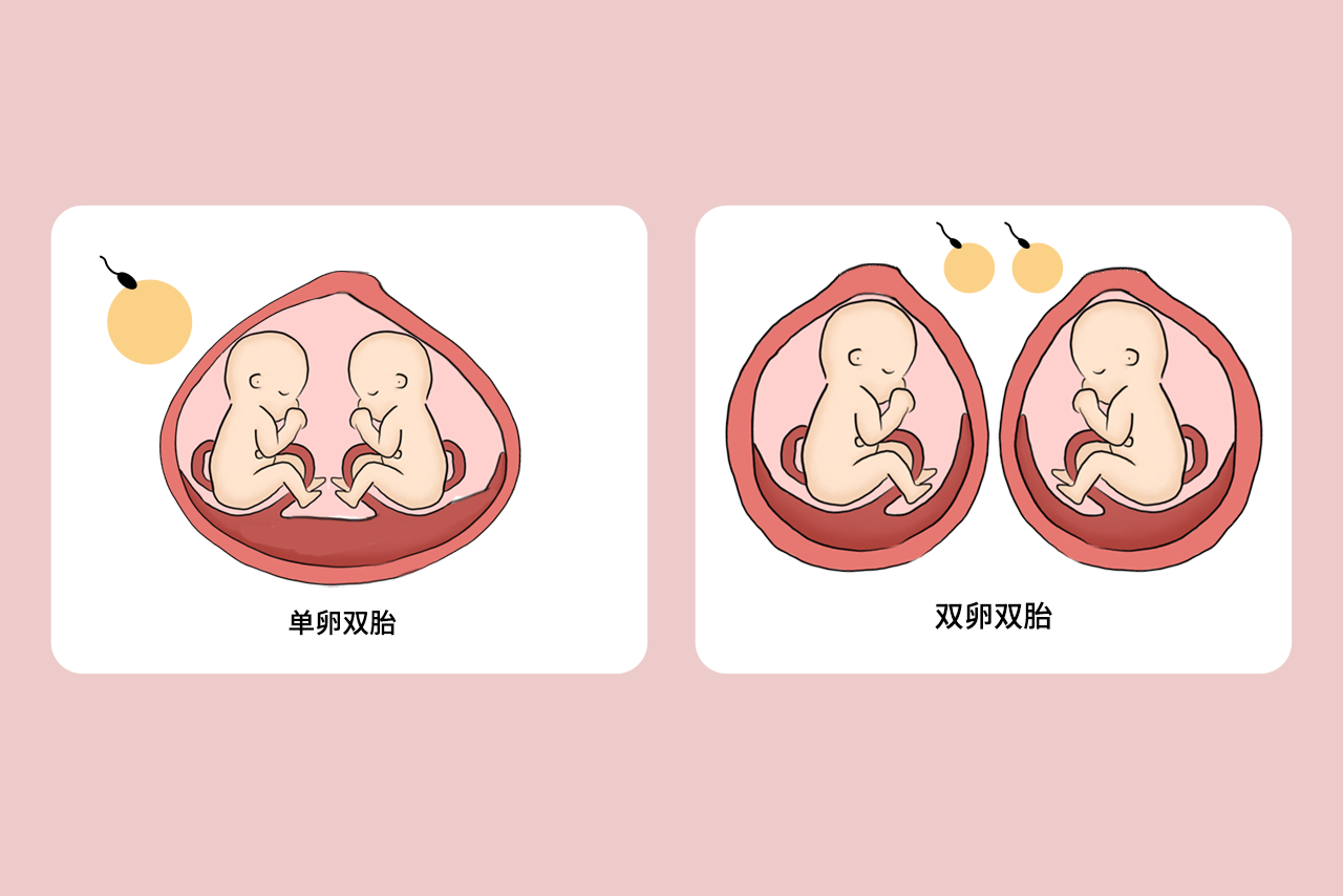 单卵双胎和双卵双胎区别图解