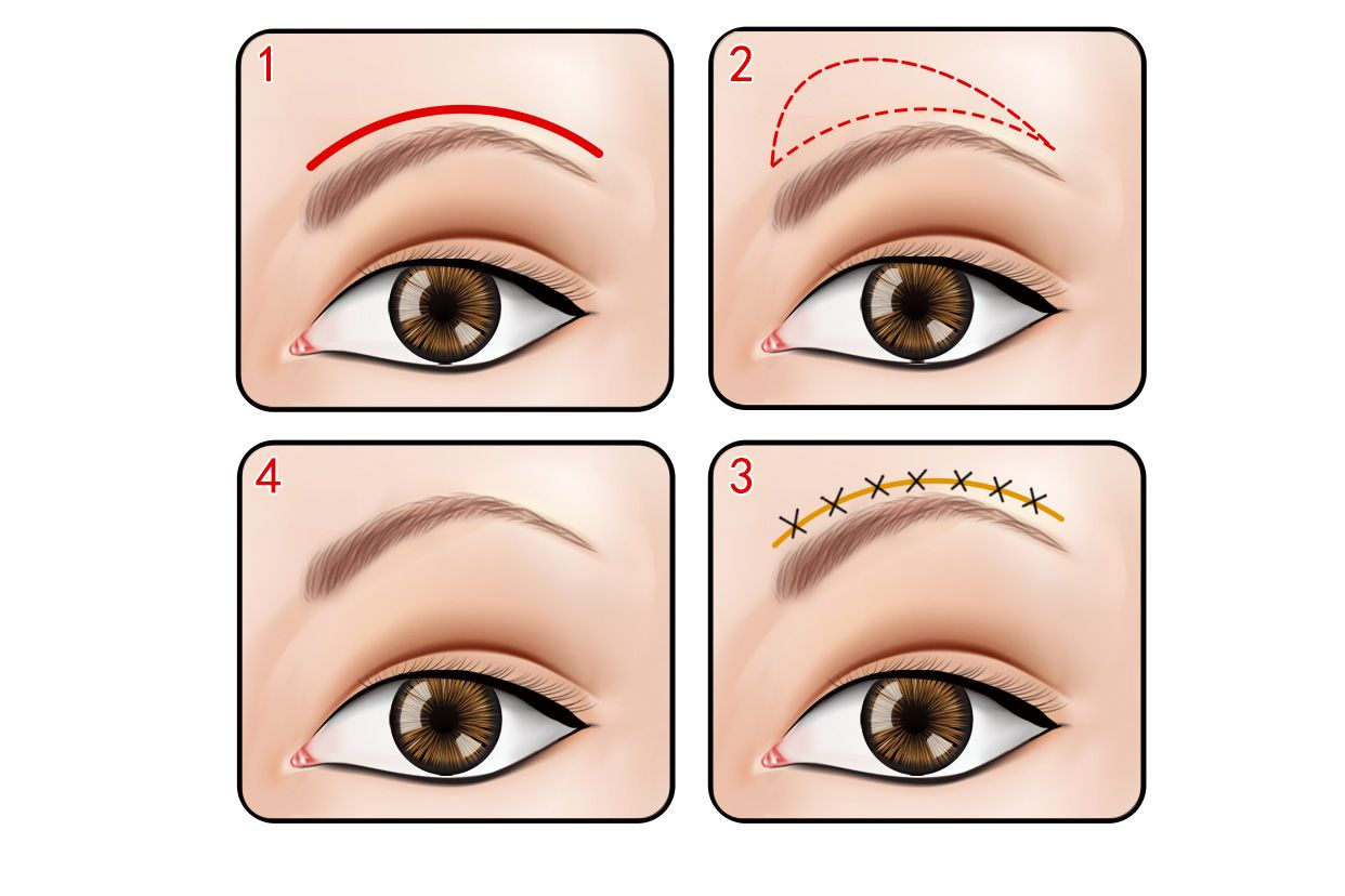 提眉手术效果图 提眉手术效果图