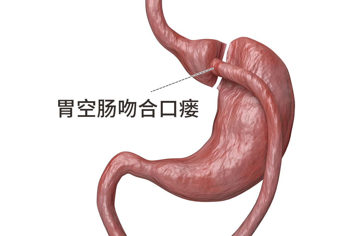 吻合口瘘图片 吻合口瘘处理方法