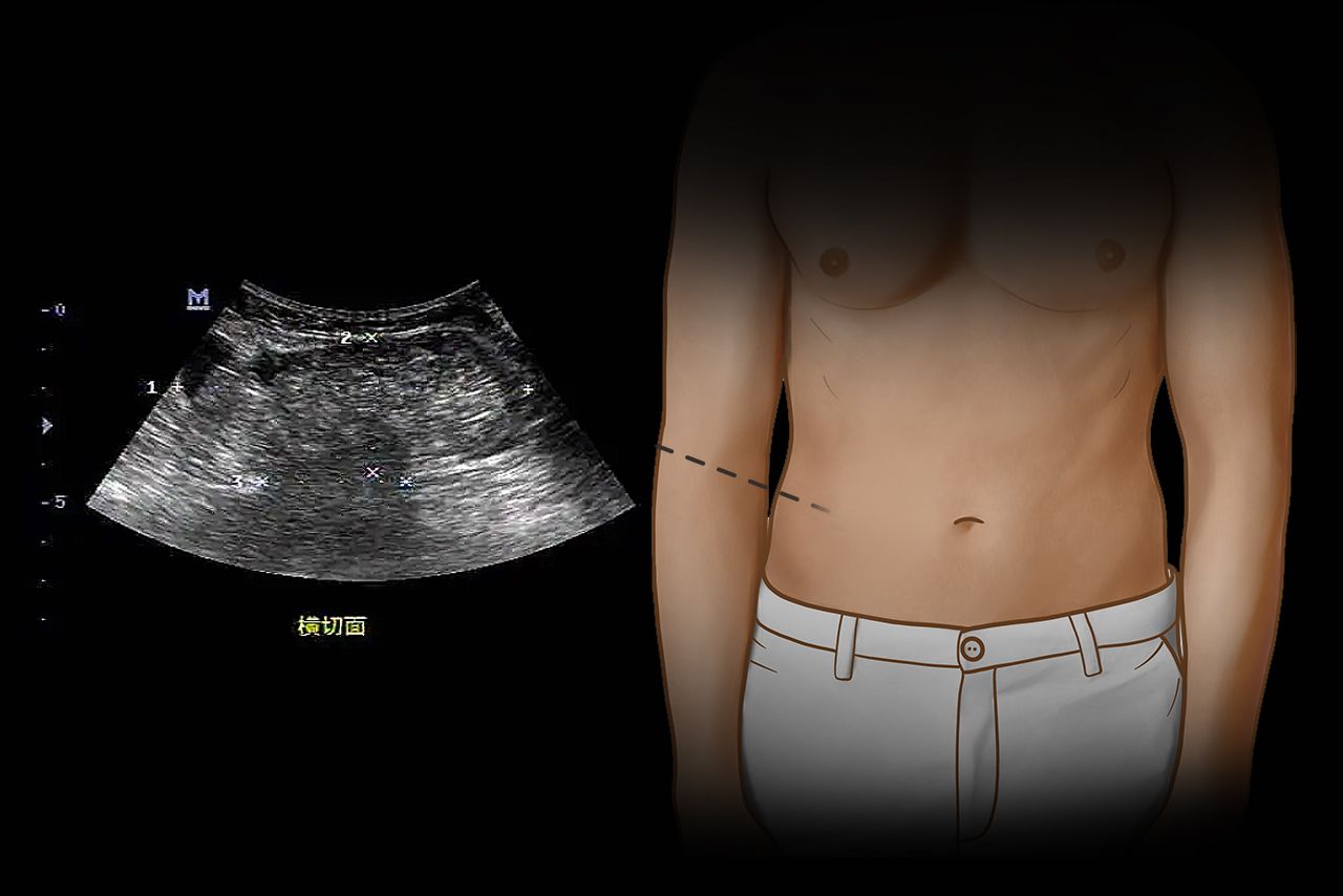 腹壁疝彩超报告图片（腹壁疝彩超报告图片高清）