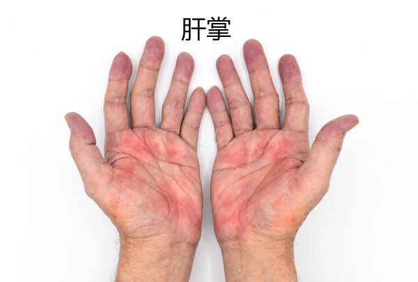 肝掌和蜘蛛痣症状图片 肝掌和蜘蛛痣的图片
