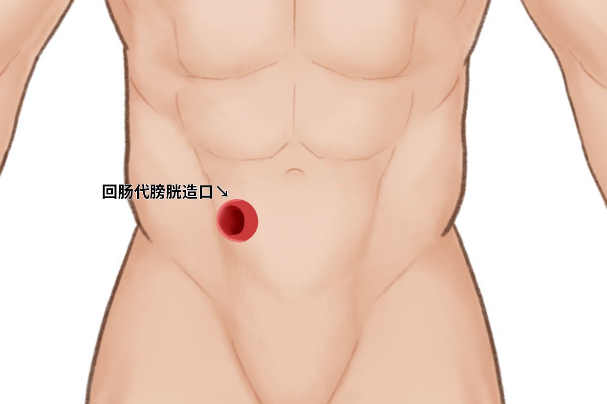 回肠代膀胱造口图片（回肠膀胱造口术图片）