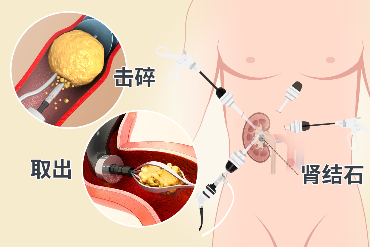 肾结石微创手术过程图（肾结石微创手术过程图 切口）