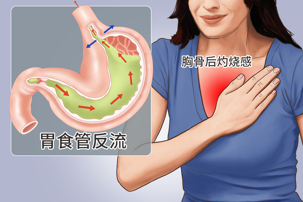 胃食管反流图片 胃食管反流的图片