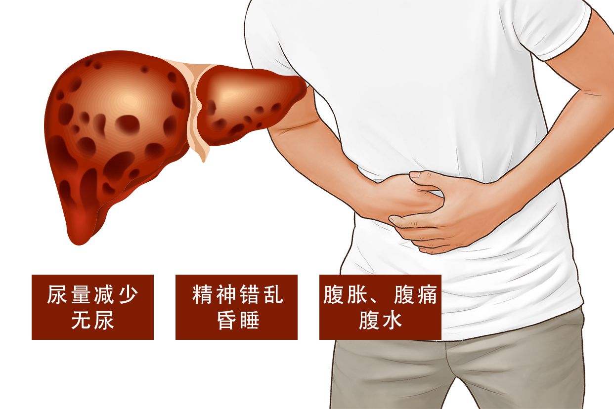 肝衰竭图片（肝衰竭-全部）