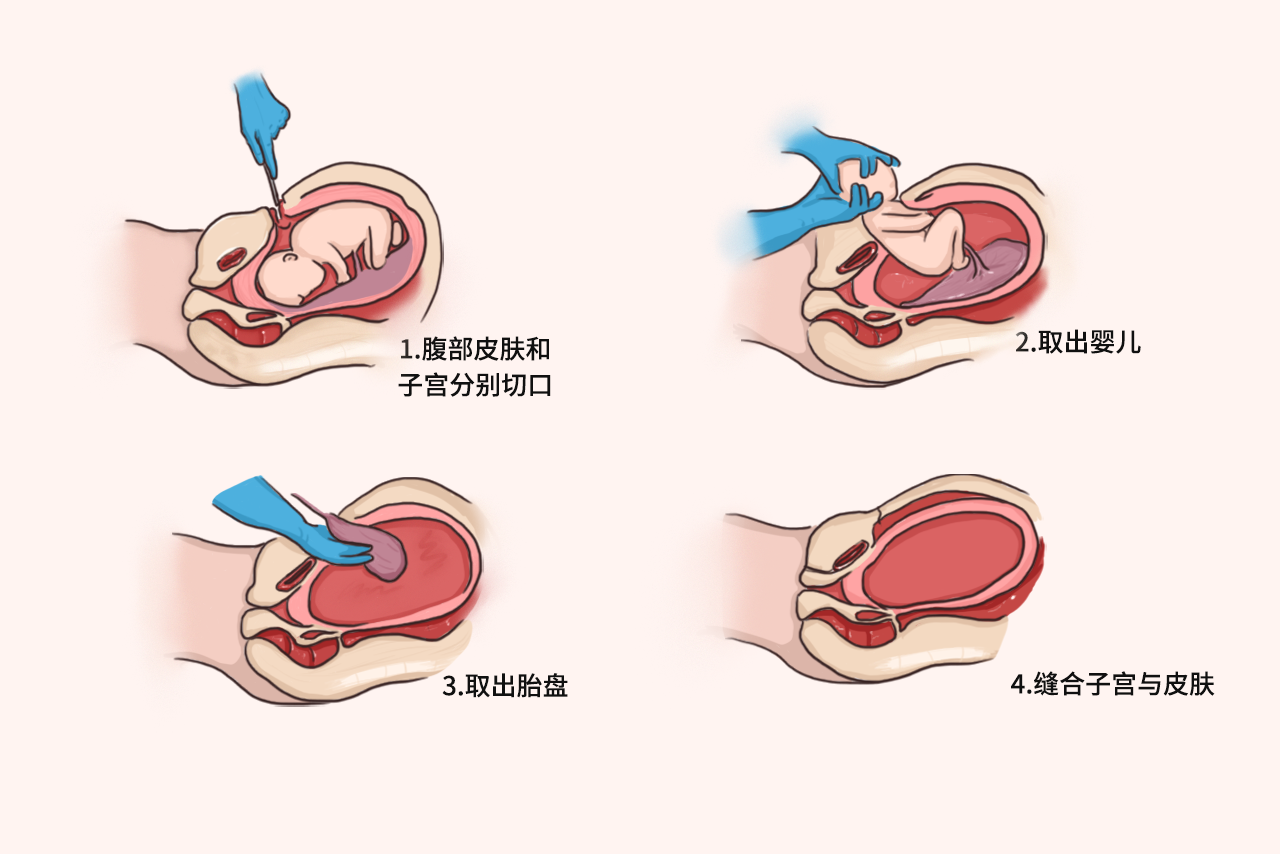 剖宫产步骤详解图解 剖腹产解剖图解