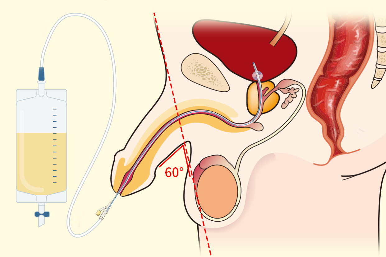 男性导尿什么时候与腹壁60度图片 男性导尿腹壁多少度