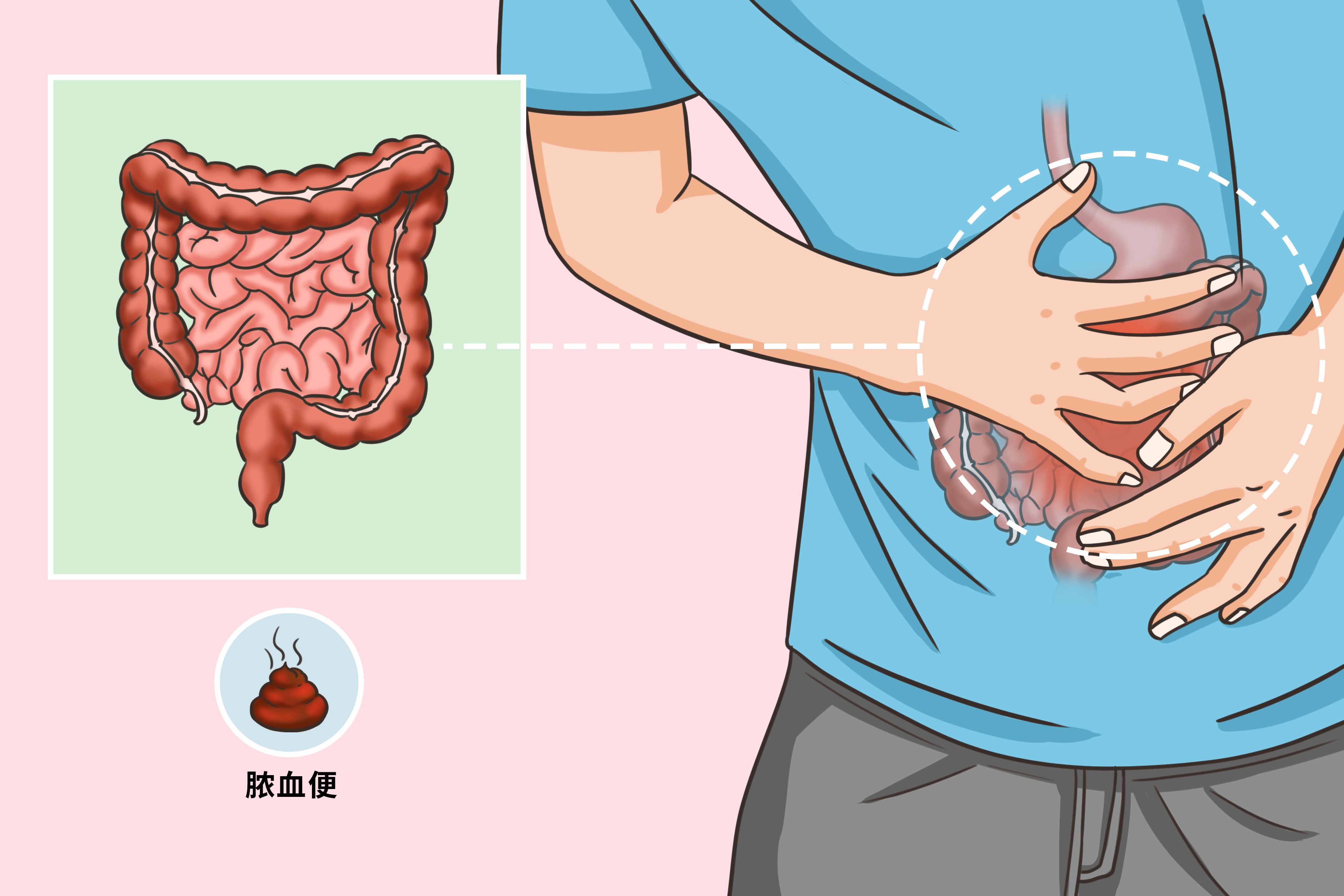 溃疡性结肠炎脓血便图片（溃疡性结肠炎 脓血便）