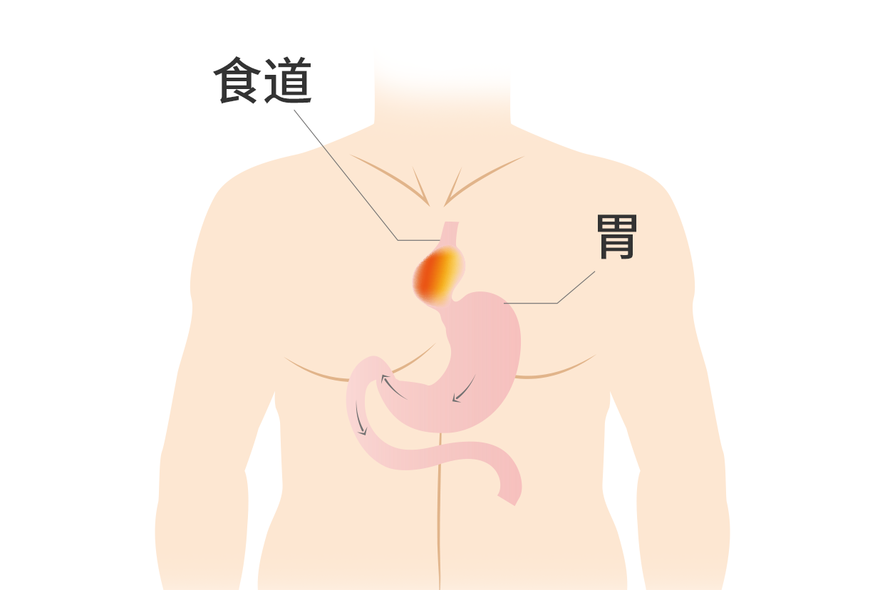 食管裂孔疝疼痛部位图（食管裂孔疝有什么症状）