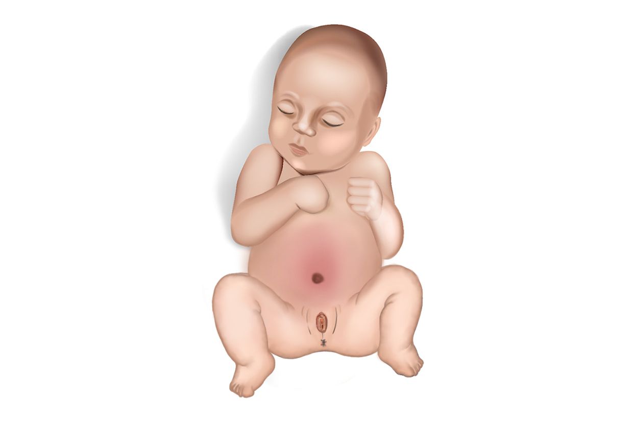 女宝宝小腹三角区鼓鼓的囊肿图片（女婴小腹下三角区肥大）