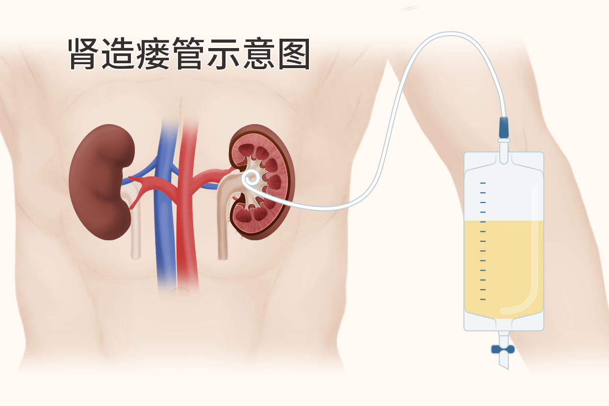 单猪尾样肾造瘘管图片（小肠造瘘管图片）