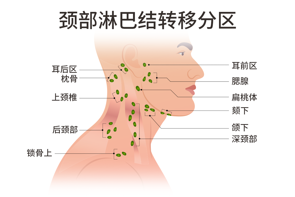颈部淋巴结转移图片（颈部淋巴结转移癌图片）