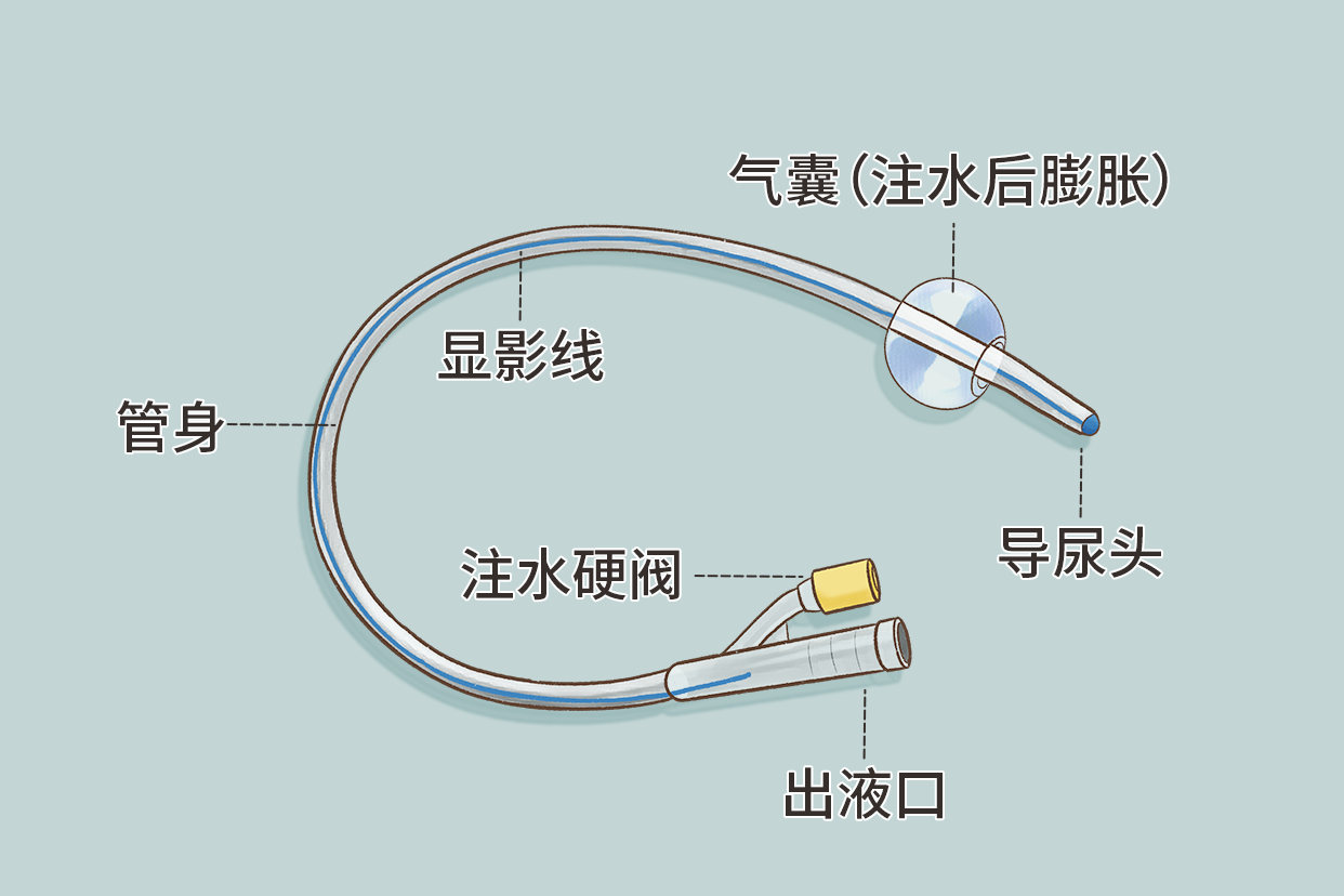 膀胱造瘘引流导尿管的图片（膀胱造瘘用什么尿管）