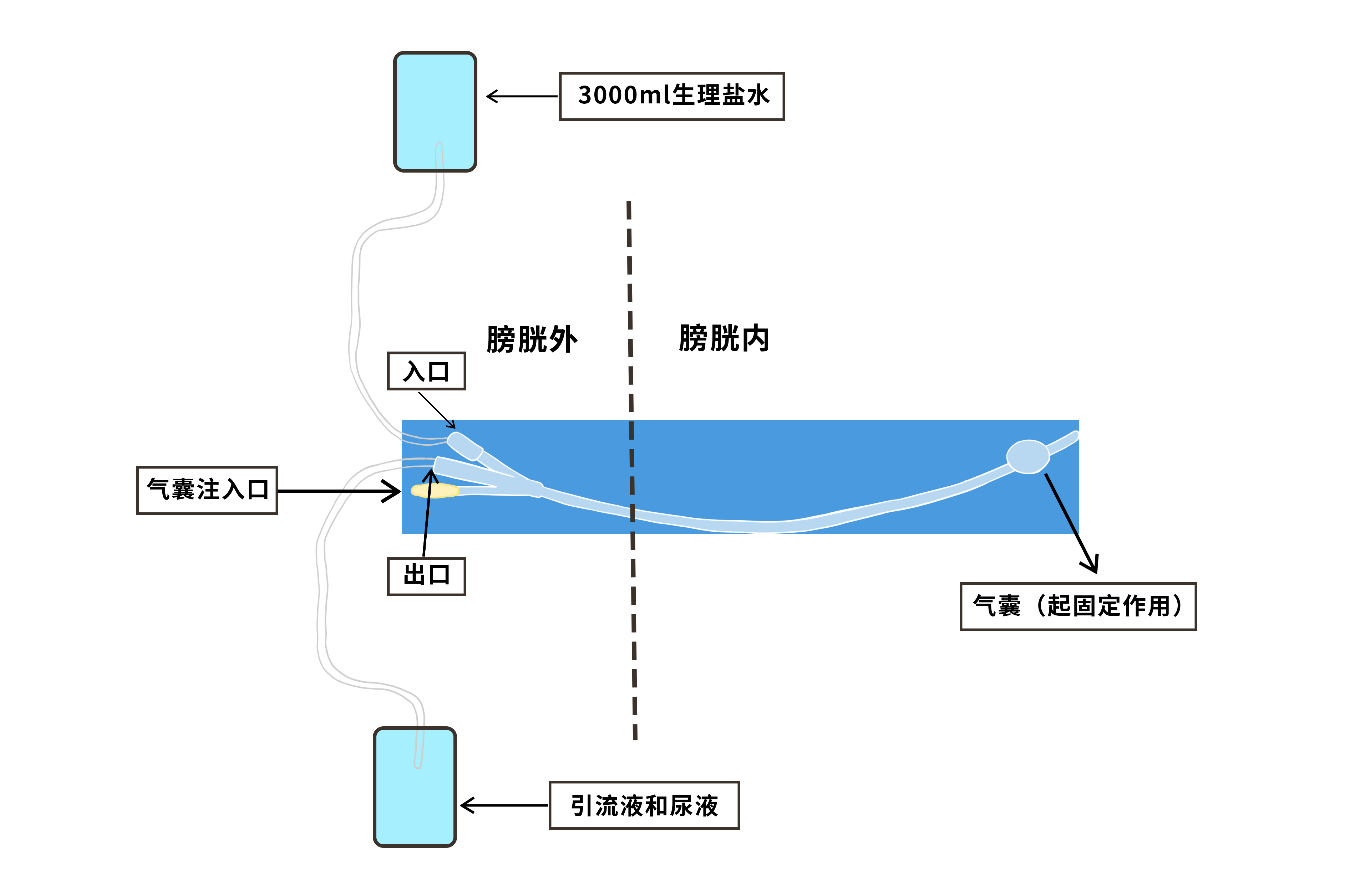 膀胱冲洗接哪个尿管头求图（三个头的导尿管怎么进行膀胱冲洗）