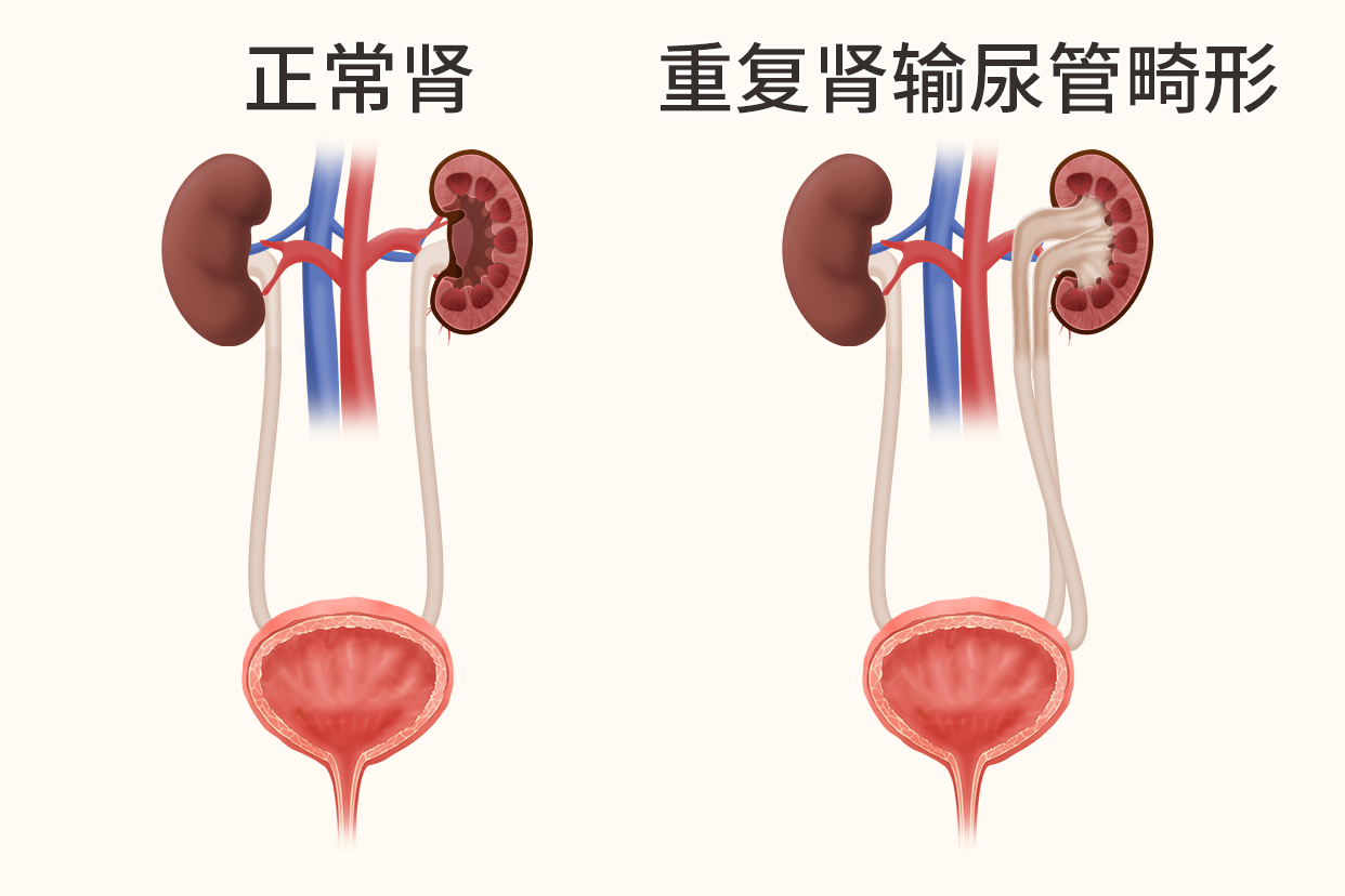 双肾双输尿管图片（双肾盂双输尿管）