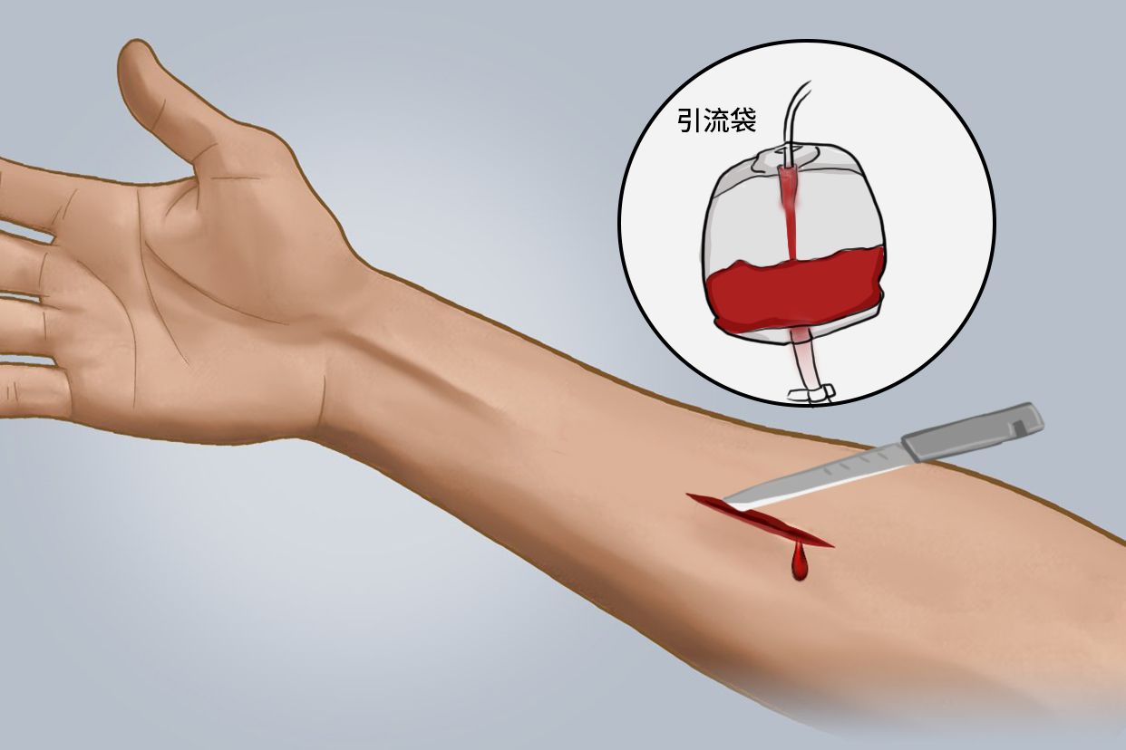 皮下血肿引流手术图片（皮下血肿引流手术视频）