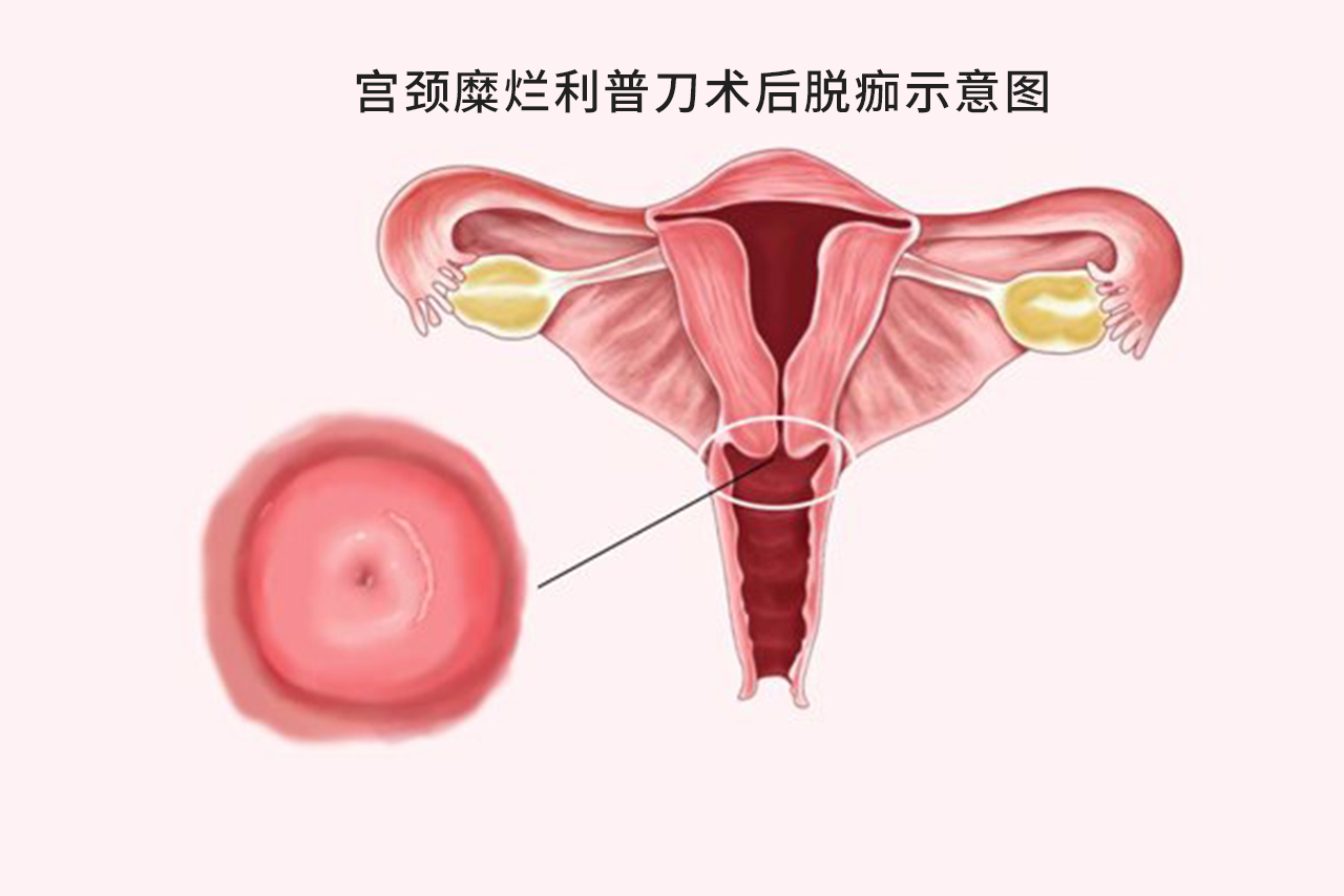 宫颈糜烂利普刀术后脱痂图片（宫颈利普刀脱痂后宫颈图片）