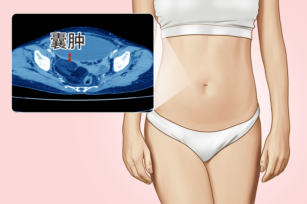 女性腹腔内巨大囊肿图片 女性腹腔内巨大囊肿图片高清