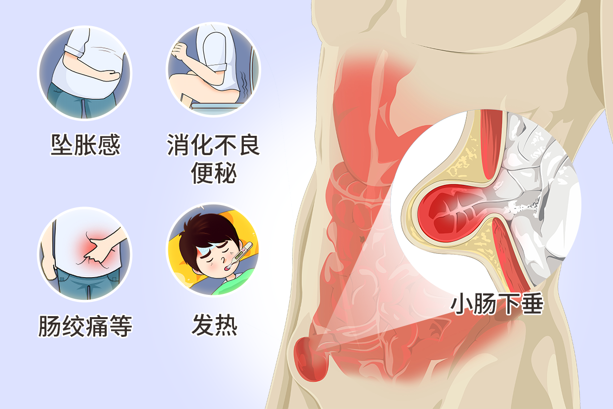什么是小肠下垂图片（什么叫小肠下垂?）