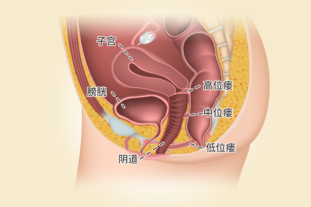 阴道瘘图片 尿道阴瘘症状