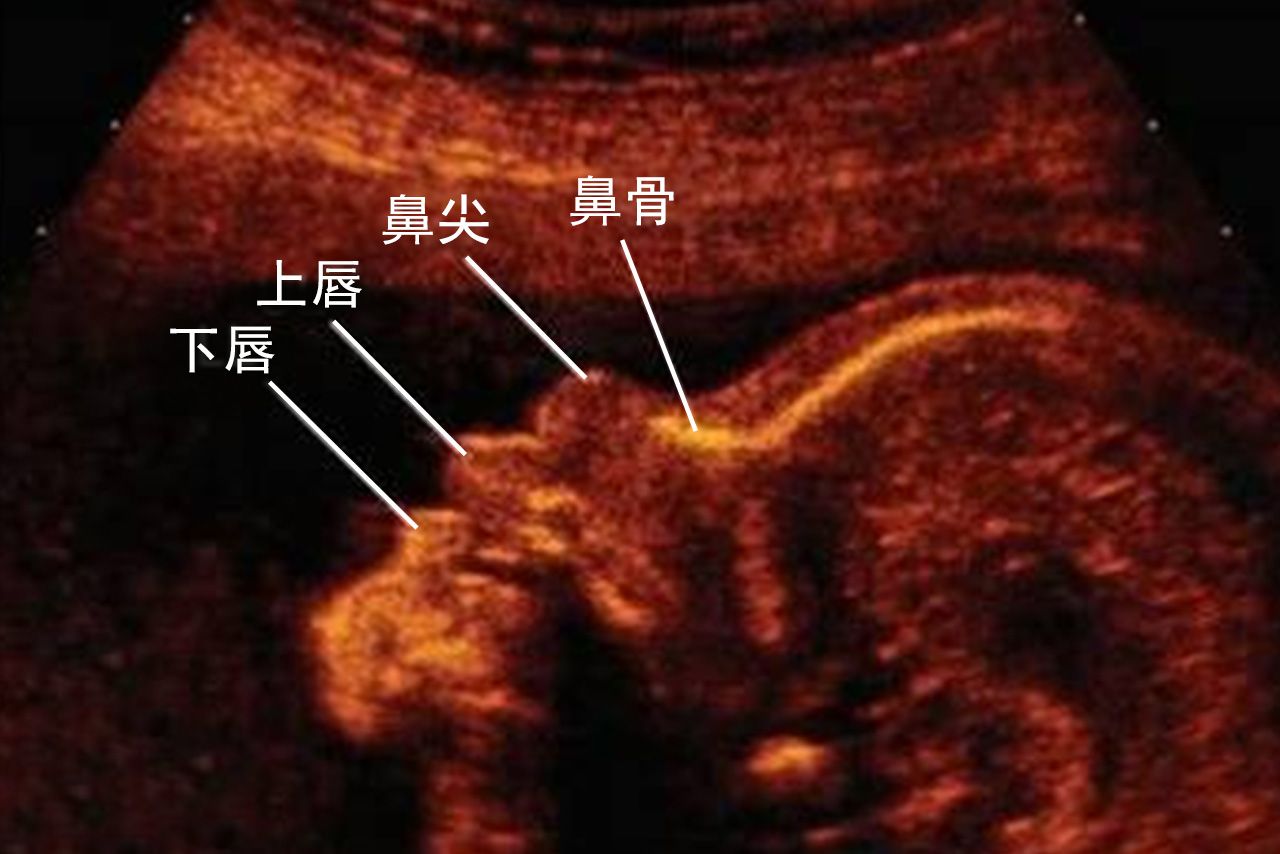 胎儿鼻骨超声切面图 胎儿鼻骨超声诊断